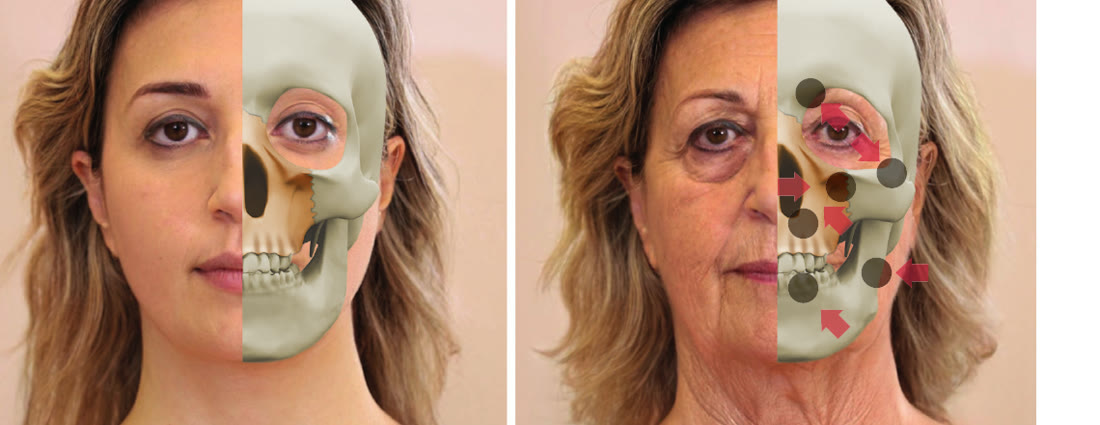 Comparación de rostro joven y envejecido con la estructura ósea superpuesta, mostrando la reabsorción del hueso facial