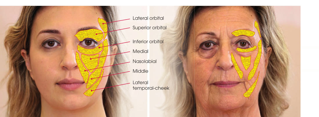 Compartimentos de grasa facial señalados sobre rostro joven y envejecido: orbitario lateral, orbitario superior, orbitario inferior, medial, nasolabial, medio y temporal-malar lateral