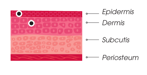 Plano de inyección Hydro Deluxe Man — epidermis y dermis