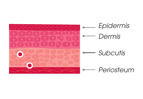 Plano de inyección Intense — subcutis y sobre el periostio