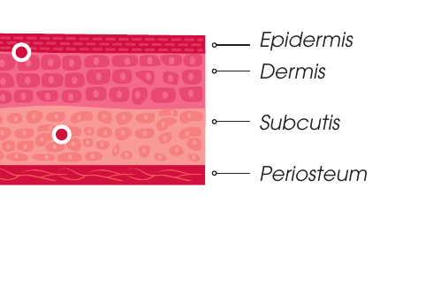 Plano de inyección Intense Flux — intradérmico y subcutis