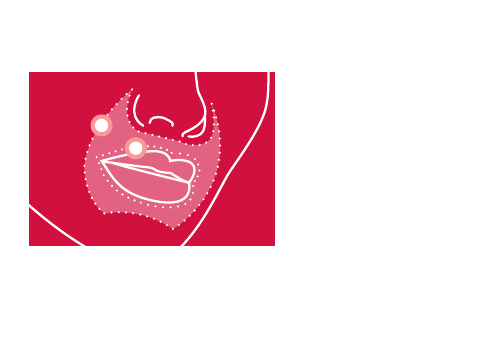 Plano de inyección Intense Lips — vermilion y zona perioral