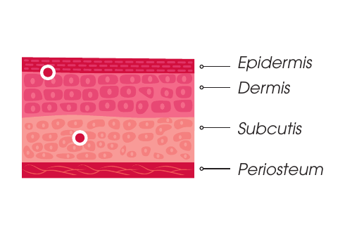 Plano de inyección Intense Rheology — intradérmico y subcutis