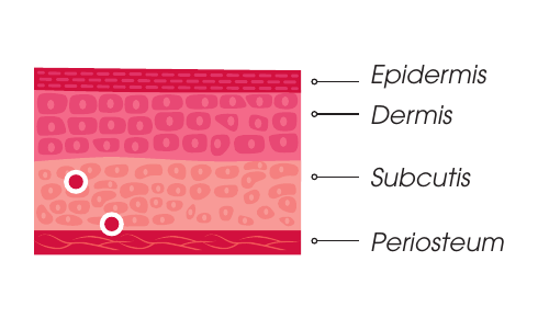 Plano de inyección Stimulate — subdermis y sobre el periostio