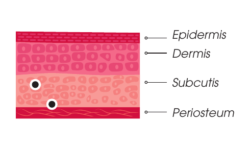 Plano de inyección Stimulate Man — subdermis y sobre el periostio