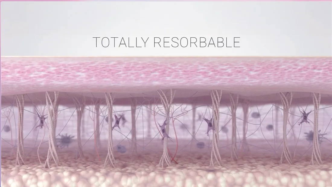 Representacion de la dermis: totalmente reabsorbible