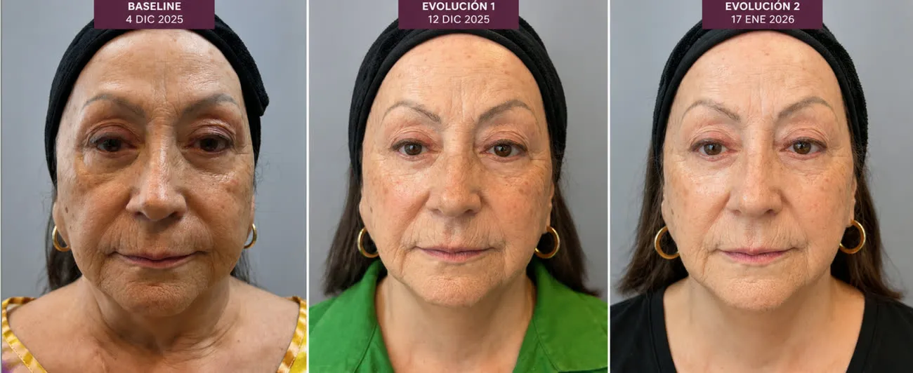 Caso de EU Loreto Rivera: baseline, evolucion 1 y evolucion 2