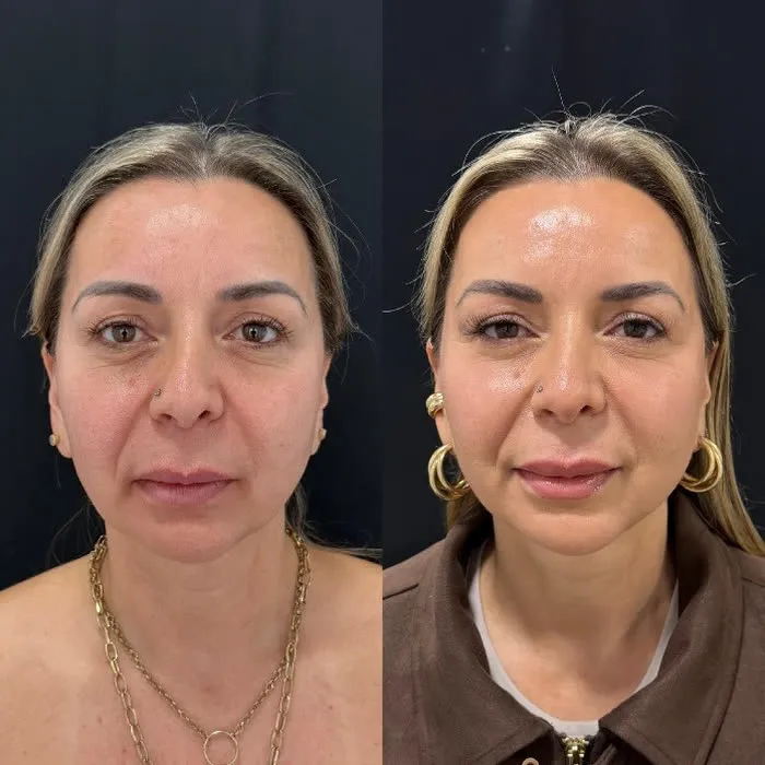 Caso de fatiga periocular del Dr. Diego Araya, antes y despues