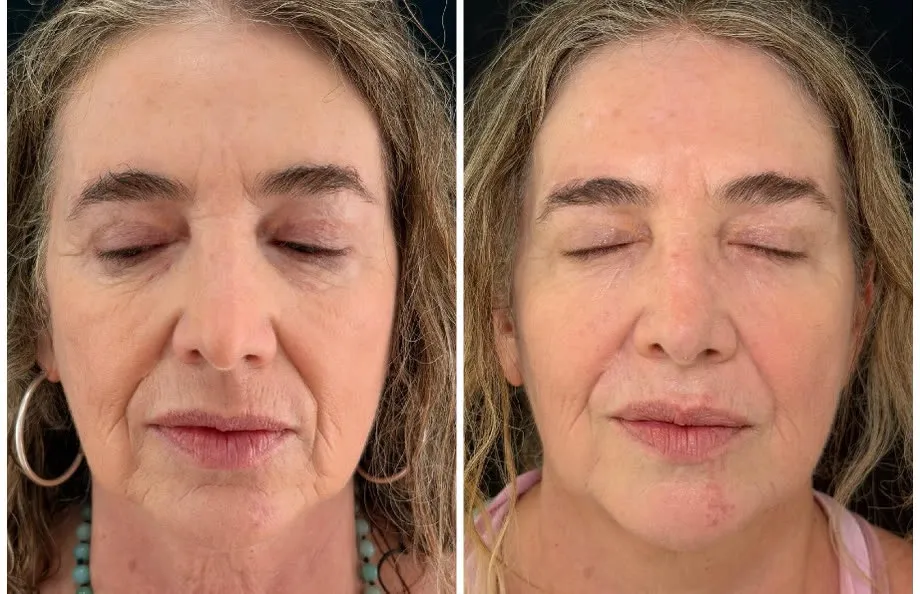 Caso de bioestimulacion de la Dra. Carla Olavarria, antes y despues