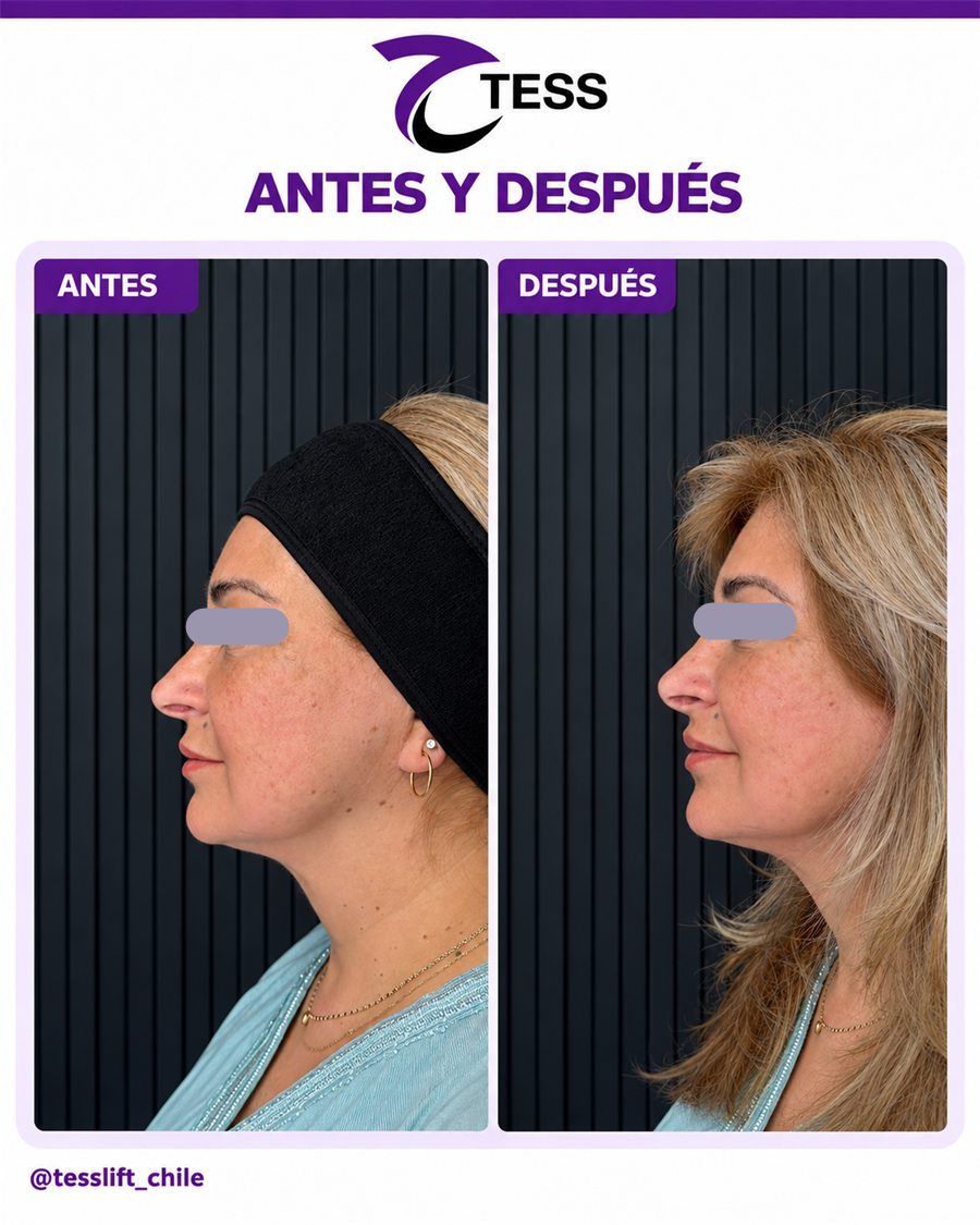 Caso clínico TESS del Dr. Javier Quilodrán, vista de perfil, antes y después