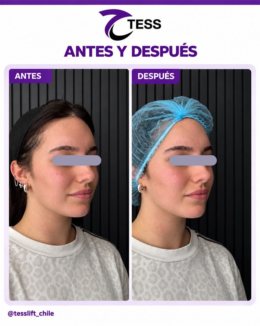 Caso clínico TESS del Dr. Javier Quilodrán, vista oblicua, antes y después
