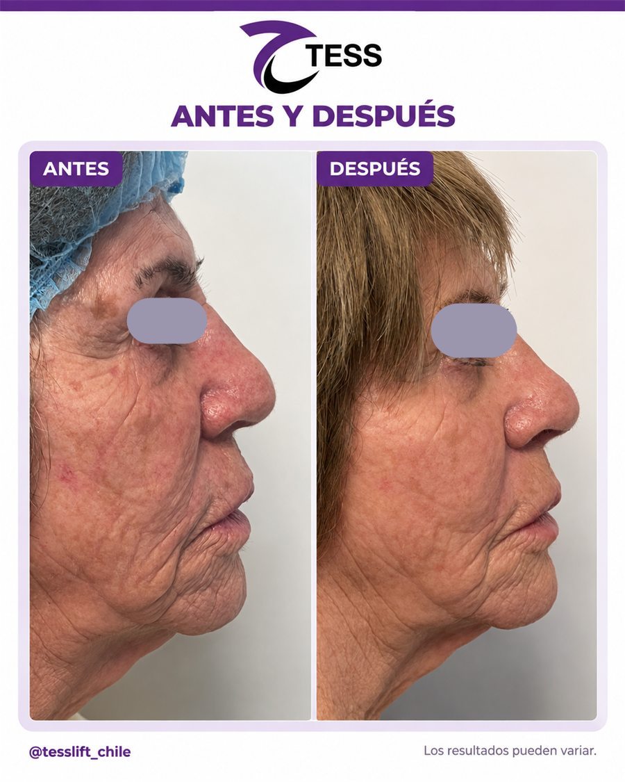 Caso clínico TESS del Dr. Javier Quilodrán, vista de perfil, antes y después