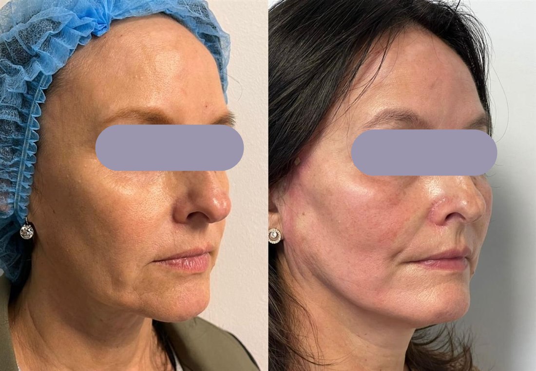 Caso de lifting facial TESS del Dr. Javier Quilodrán, vista oblicua izquierda, antes y después