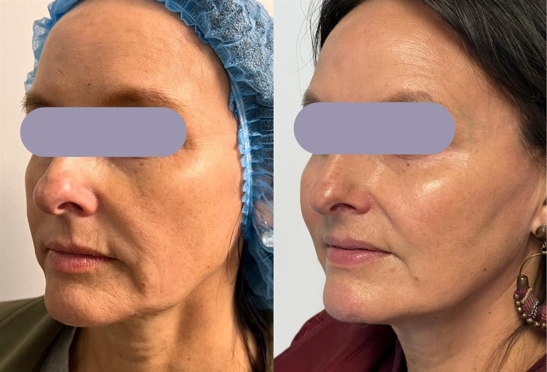 Caso de lifting facial TESS del Dr. Javier Quilodrán, vista oblicua derecha, antes y después