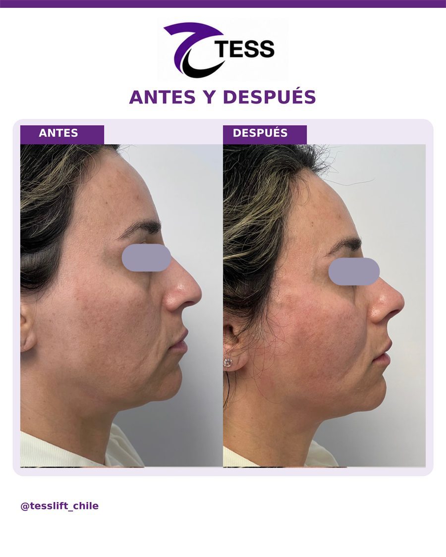 Caso clínico TESS del Dr. Javier Quilodrán, vista de perfil, antes y después