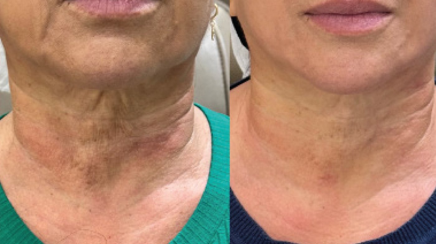 Fuente: zneck.com.br (sitio oficial Neauvia Brasil), cortesía de la Dra. Daniela Faccioni Caso clínico de cuello tratado con Zaffiro: antes a la izquierda, después a la derecha