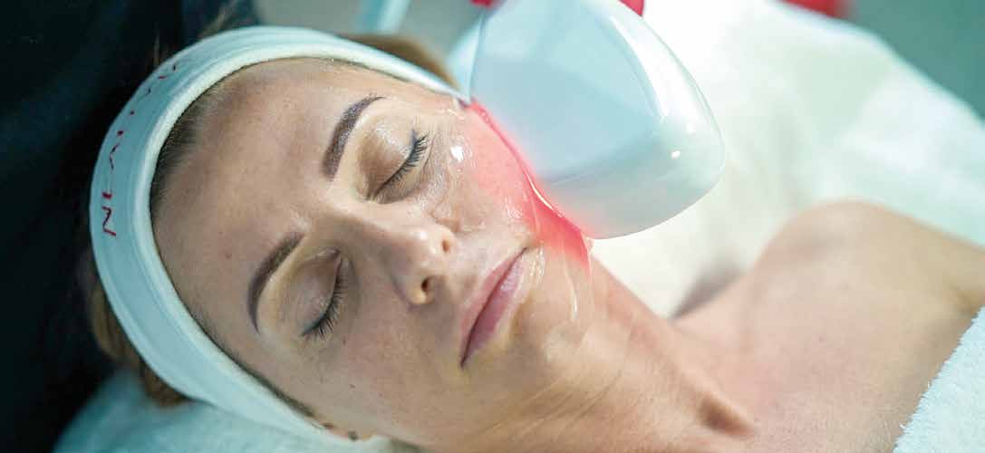 Aplicación clínica real de Zaffiro ThermoLifting sobre paciente